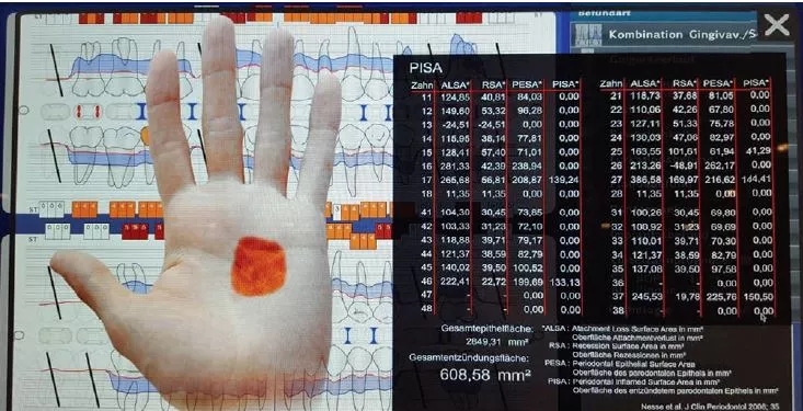Visualisierung der entzündeten Fläche im Mund des Patienten, dargestellt über die PISA-Einstellung.