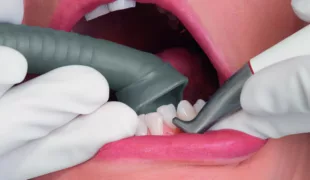 Die Prophylaxe-Kanüle von DÜRR DENTAL in der Anwendung.