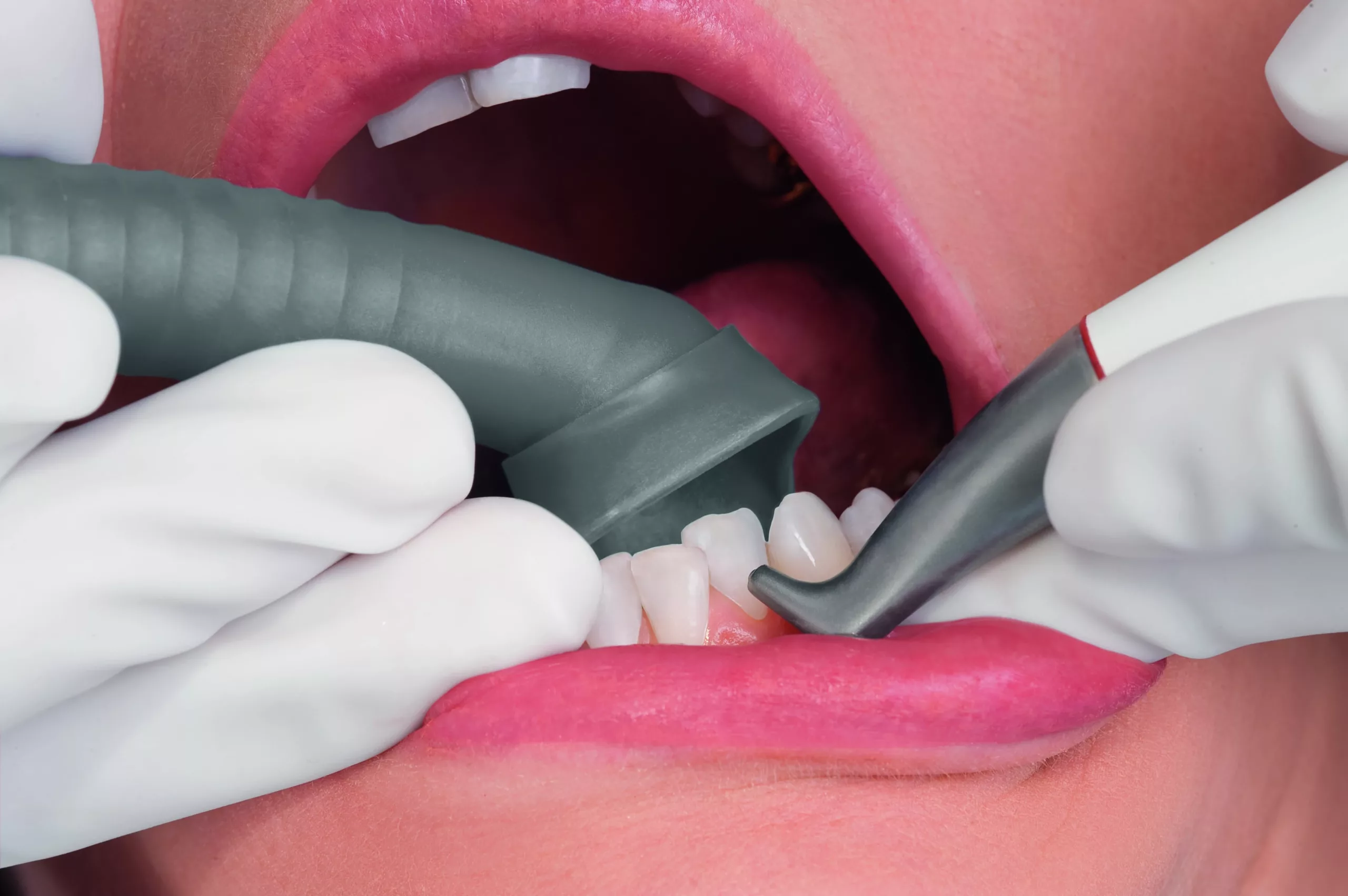 Die Prophylaxe-Kanüle von DÜRR DENTAL in der Anwendung.
