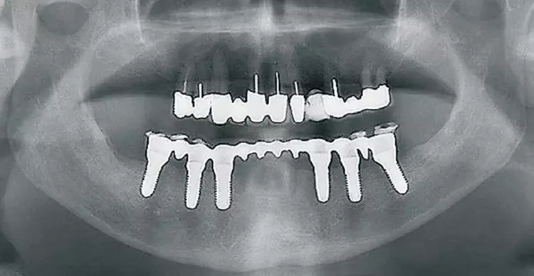Abb. 1-4: Sofort- und Spätimplantationen im UK mit Abformungen der Implantate, Bissnahme und Einsetzen des Provisoriums in nur einer Sitzung. Mit Superhartgips ohne Zahnfleischmasken wird das Meistermodell erstellt, die Post-Aufbauten angepasst und – entsprechend der Einschubrichtung – präpariert. Dann wird die Brücke konstruiert und fertiggestellt.