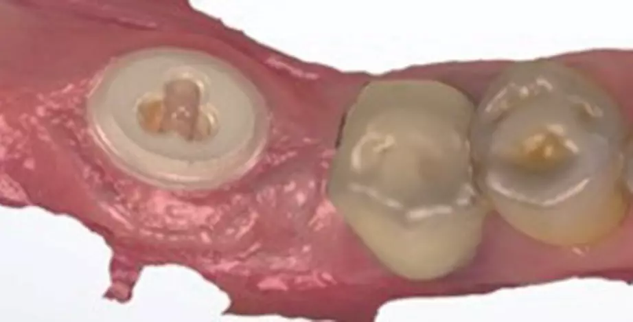 Abb. 7 und 8: BioWin!s kann man sowohl ohne als auch mit dem (bereits eingeklebten) Glasfaser-Post-Aufbau mit einem Intraoralscanner abscannen und die Krone erstellen.