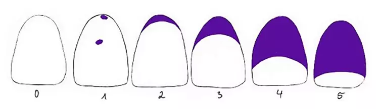 Abb. 1: Quigley-Hein-Index.