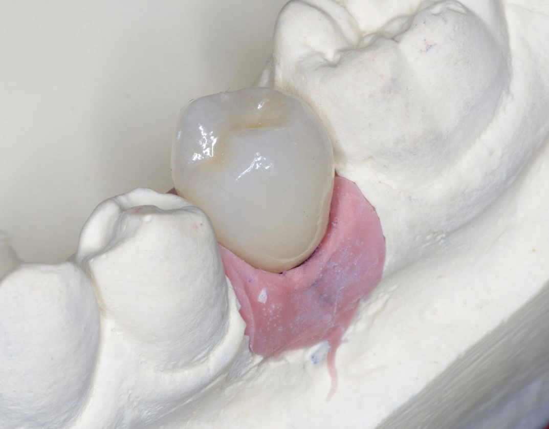Keramikkrone auf Implantat, ...