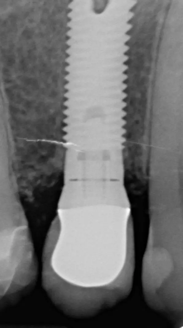 Abb. 2: Emergenzprofil, mesial zeigt das Emergenzprofil des Abutments einen geraden, distal einen konvexen Verlauf.