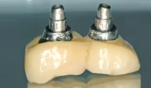 So sollte eine Implantatkrone im subgingivalen Bereich auf keinen Fall gestaltet und verarbeitet werden.