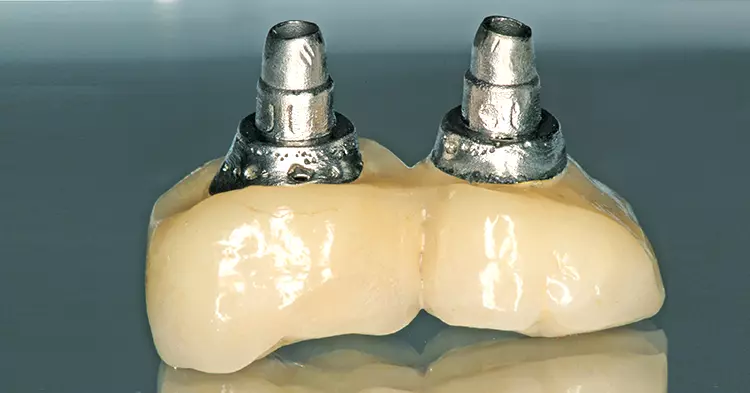 So sollte eine Implantatkrone im subgingivalen Bereich auf keinen Fall gestaltet und verarbeitet werden.