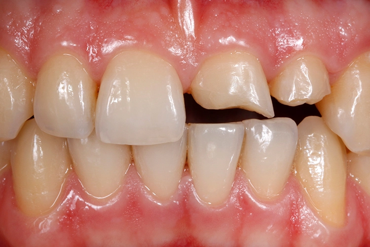 Abb. 1: Ausgangssituation: Frakturierte Schneidezähne im linken Oberkiefer nach einem Trauma. Zahn 22 ist final endodontisch behandelt. Zahn 21 ist trepaniert, im Wurzelkanal befindet sich Kalziumhydroxid als temporäre Einlage.