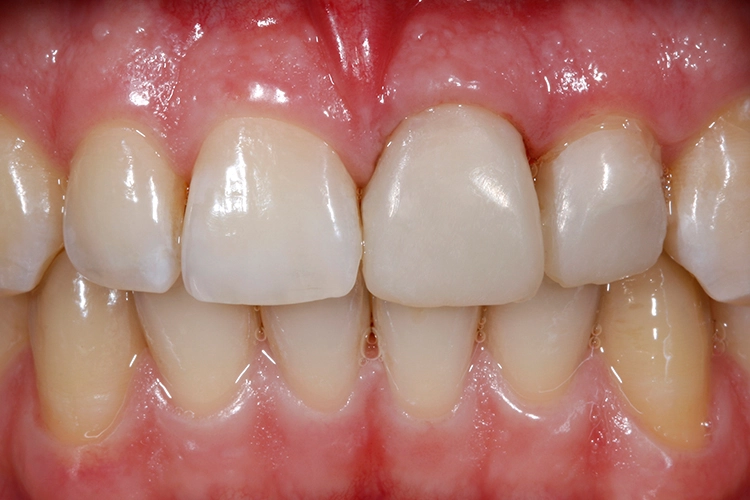 Abb. 13: Endergebnis: Chairside hergestelltes Provisorium (Structur 3, VOCO). In der nachfolgenden Sitzung soll die Extraktion Zahn 22 mit Sofortimplantation
folgen.