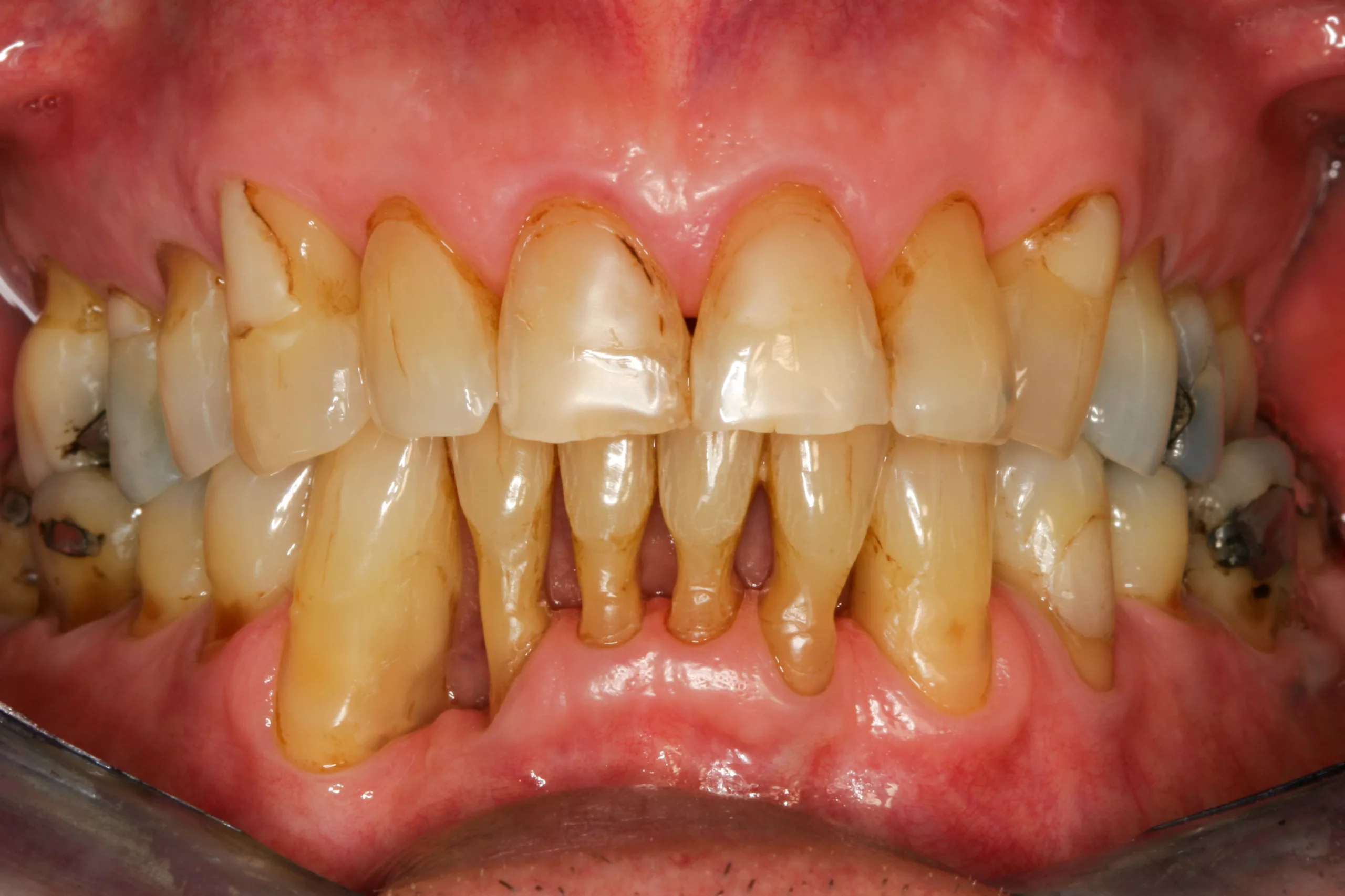 Abb. 6: Freiliegende Dentinareale bei einem langjährigen UPT-Patienten.