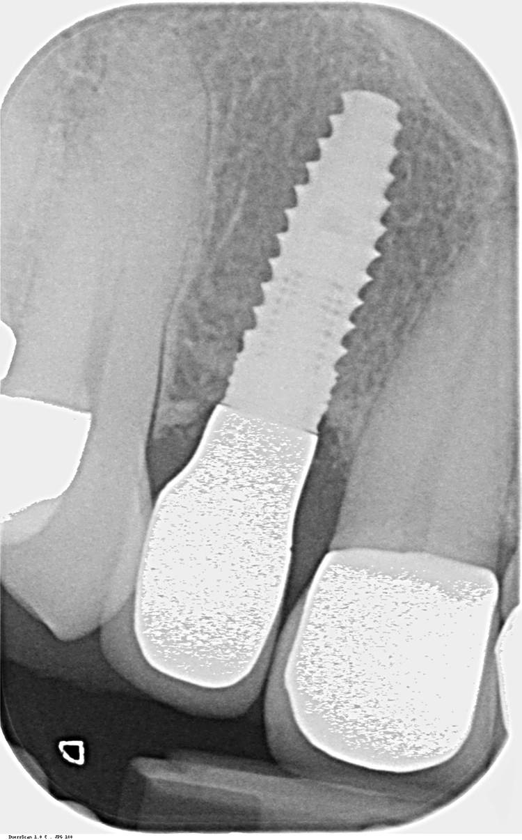 Abb. 2: Zahnfi lm ein Jahr nach Implantation.
Periimplantär zeigen sich stabile, gut
ausgebildete knöcherne Strukturen sowie
eine vollständige Integration des Implantats.
Das biomimetische Knochenregenerationsmaterial
CERASORB® Foam wurde
vollständig resorbiert und in körpereigenen
Knochen umgebaut.
