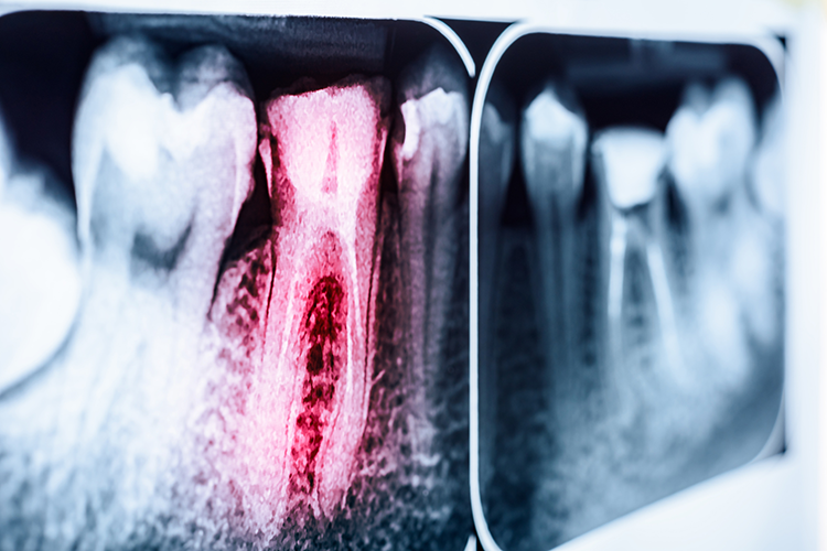 Roentgenaufnahme-mit-entzuendetem-roten-Zahn-Endodontie