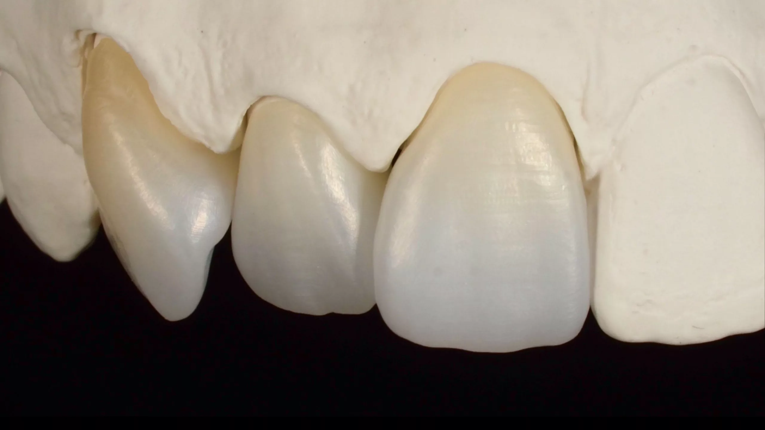 Abb. 11: Gesinterte Kronen aus Zirkonoxid.