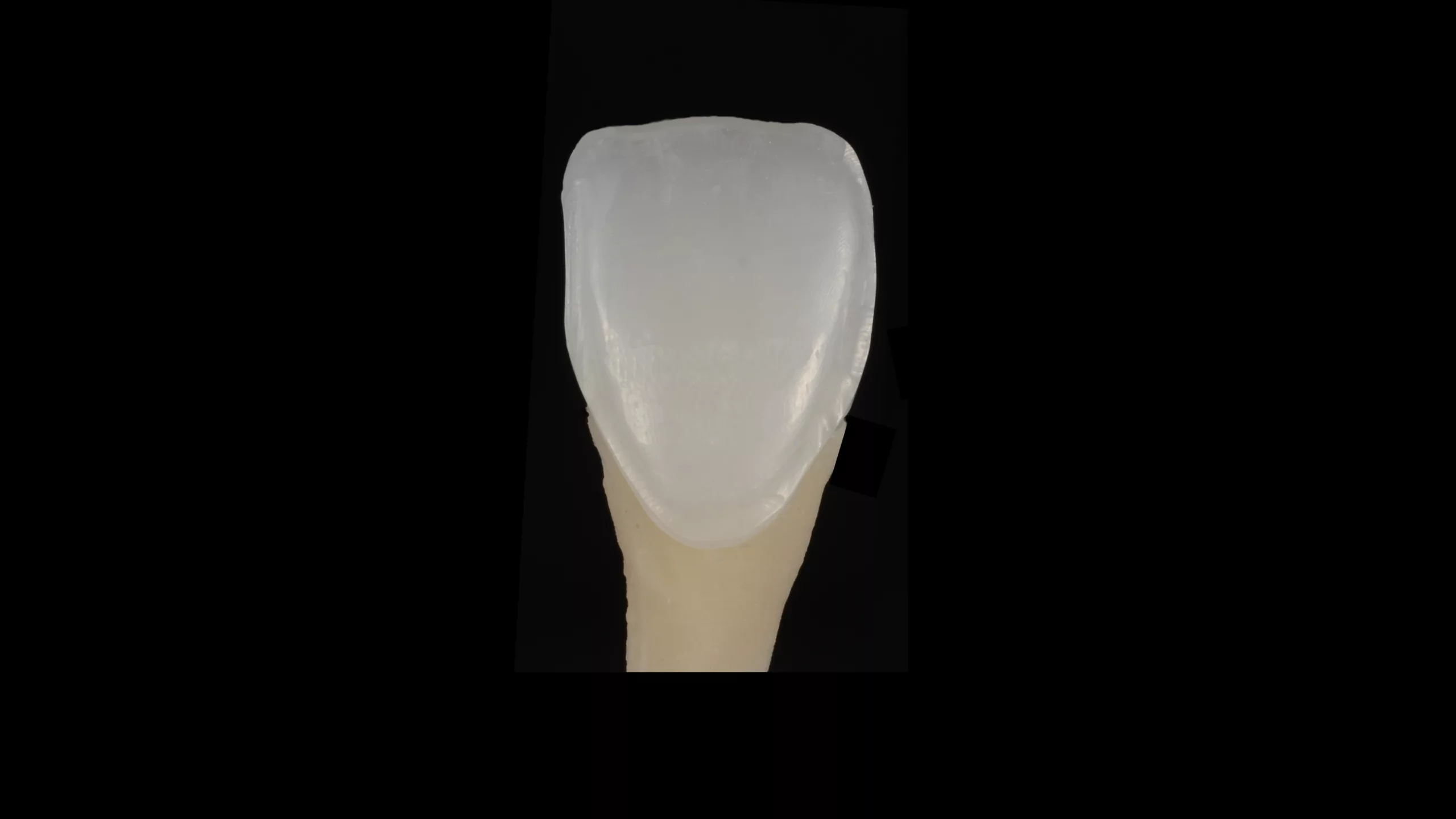 Abb. 14: Krone aus Zirkonoxid, 0,3 mm, labial reduziert.