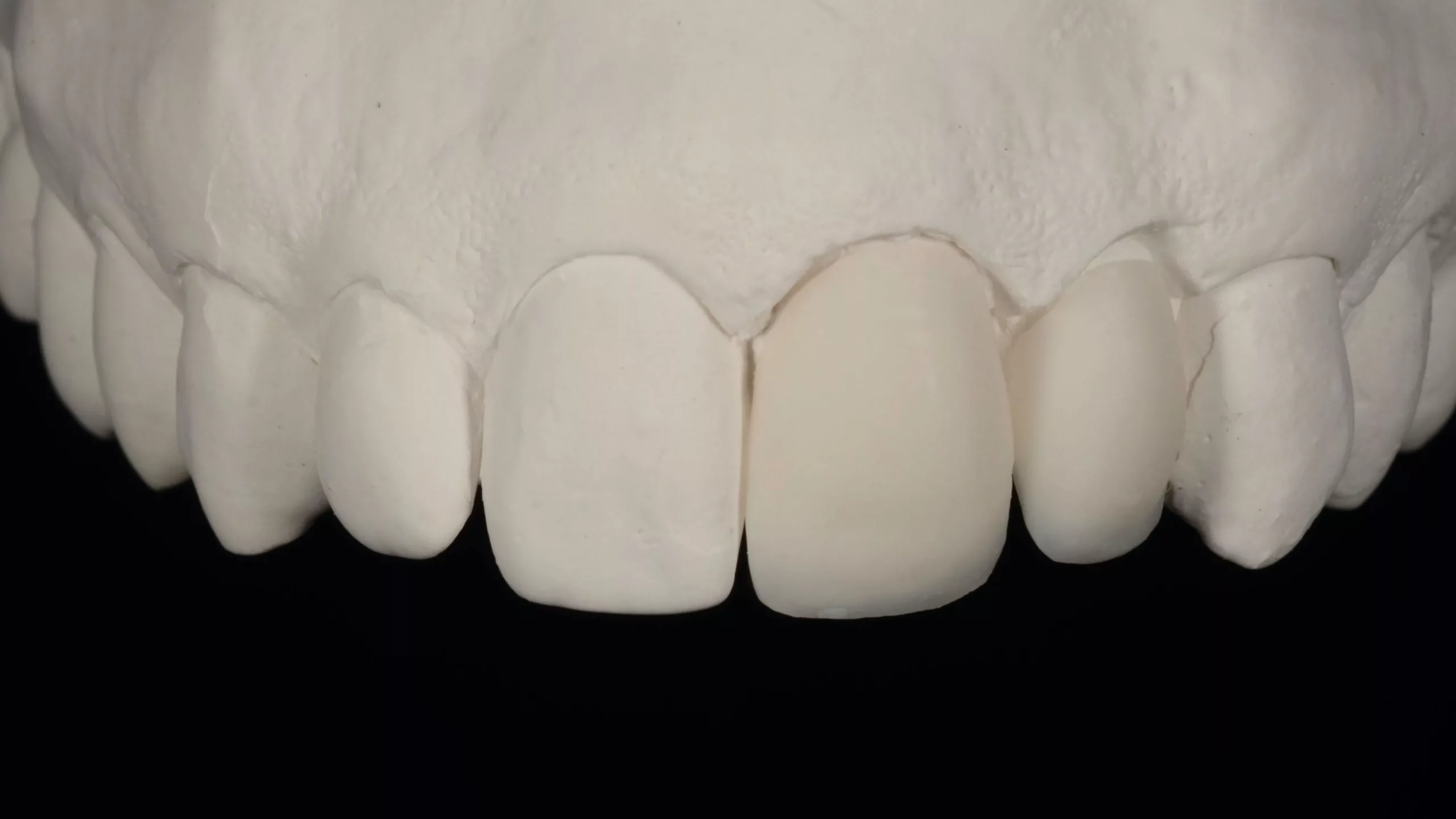 Abb. 18 bis 20: Initial LiSi Press (LT-B0) Veneers, labial minimal reduziert.