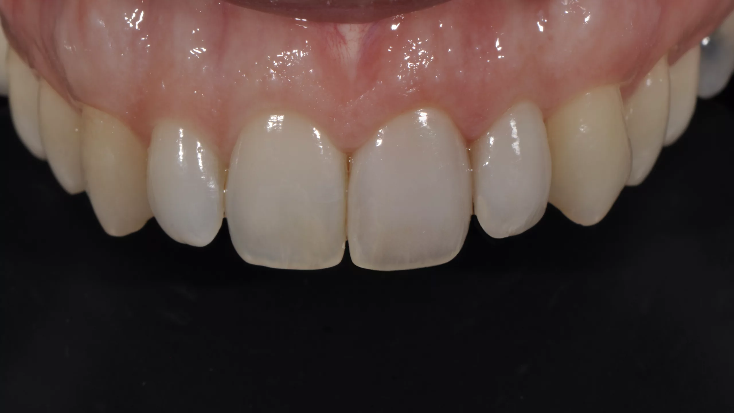Abb. 25: Klinisches Ergebnis (Zahnarzt: Dr. Johannes Bantleon, Wien).