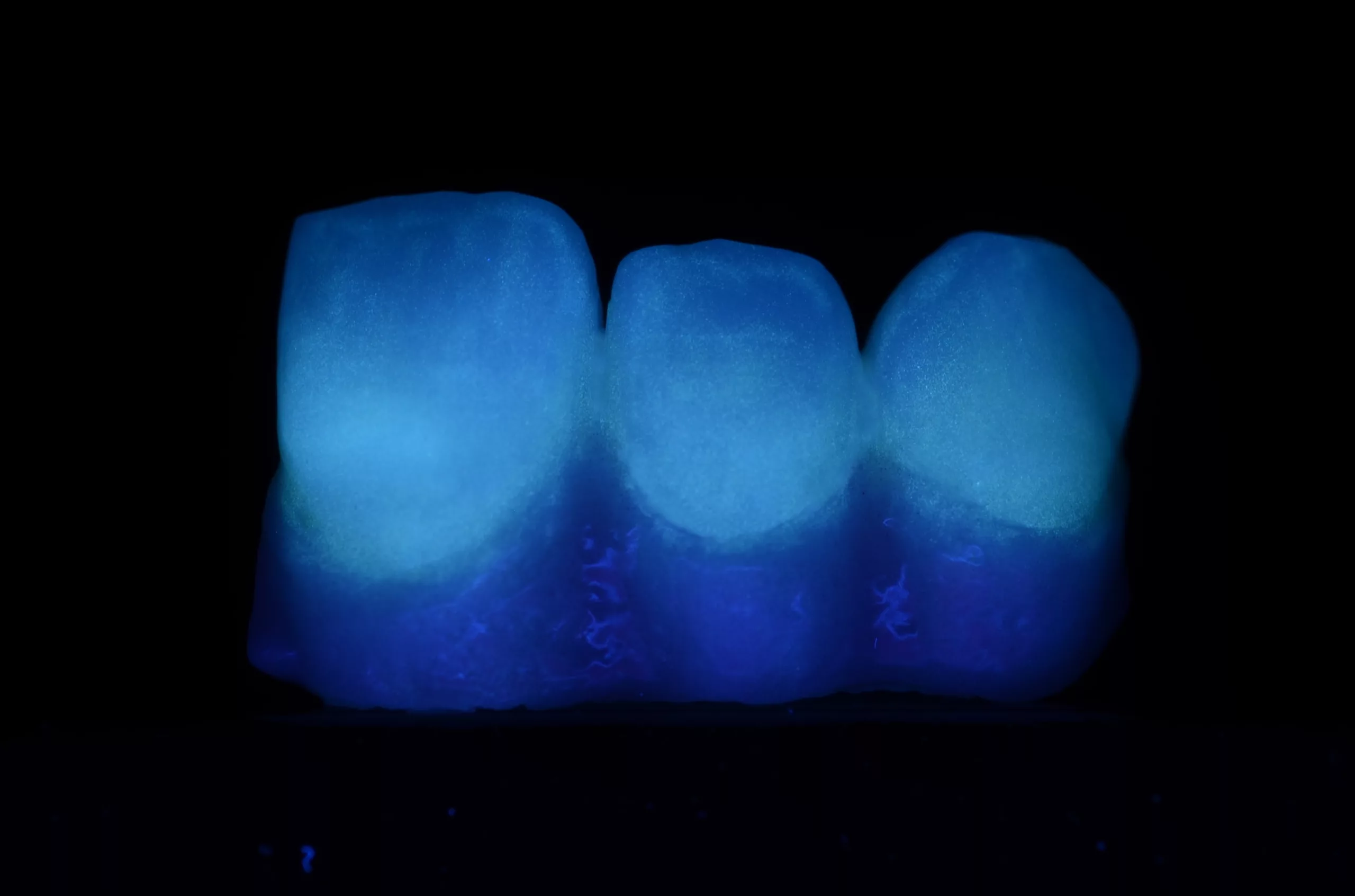 Abb. 30: Fluoreszenz der zahnfarbenen Bereiche und fehlende Fluoreszenz des gingivafarbenen Bereiches.
