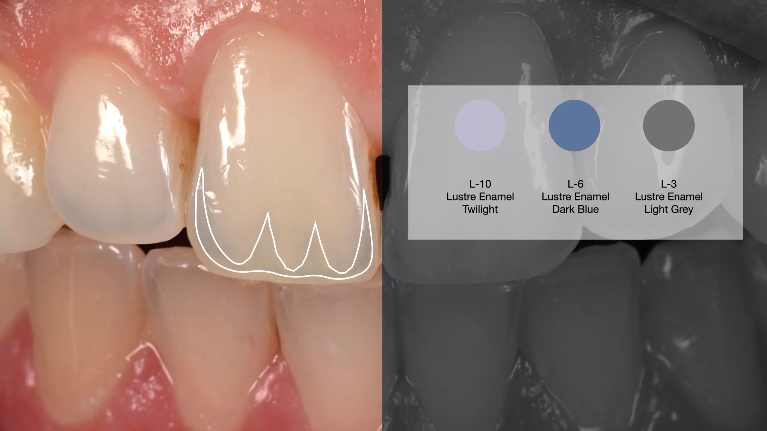 Abb. 4: Die inzisale Zone wird mit absorbierenden Farben imitiert. Bläuliche, violette und graue Pasten (L-10, L-6, L-3 usw.) erzeugen die Illusion von Transparenz. Weitere Effekte wie White Spots, feine Risse oder die Nachbildung des Halo-Effekts führen zu noch mehr Dynamik und Lebendigkeit.