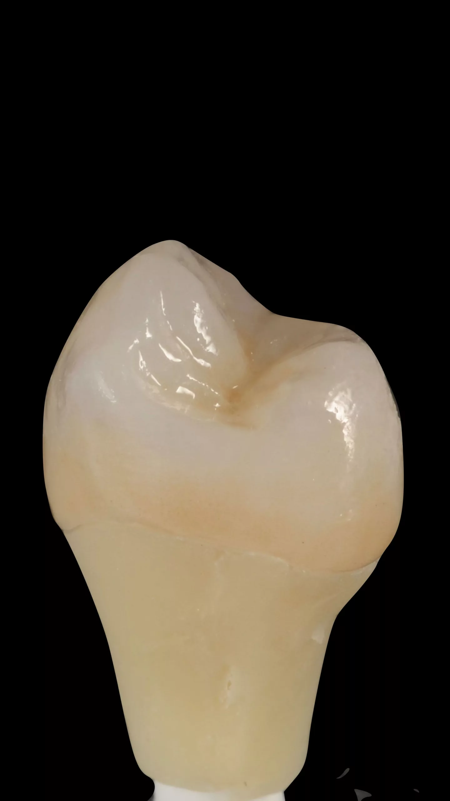 Abb. 8: Fertiggestellte Krone.