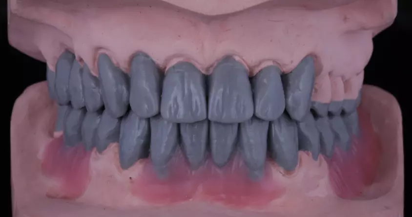 Abb. 1a: Wax-up von frontal.