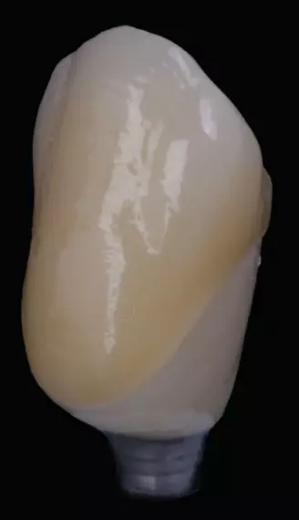 Abb. 9b: Fertige Krone von mesial.