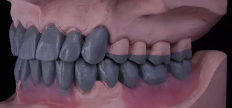 Abb. 1b: Wax-up von ...