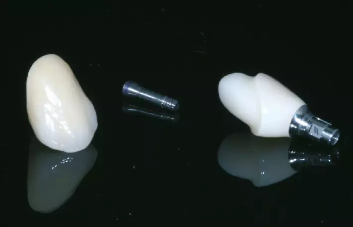 Abb. 10a: Hybrid-Abutment mit Schraube und fertiger Krone.