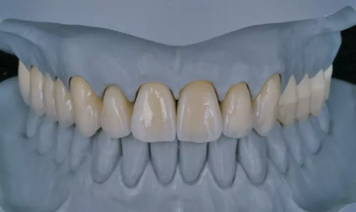 Abb. 10b: Fertige Arbeit – Metall-Keramik-Brücke 11–17, Farbmuster 21 und 22, verblendete Zirkoniumdioxidkrone auf Presskeramik-Hybrid-Abutment 23, Aufbissbehelf 24–27.