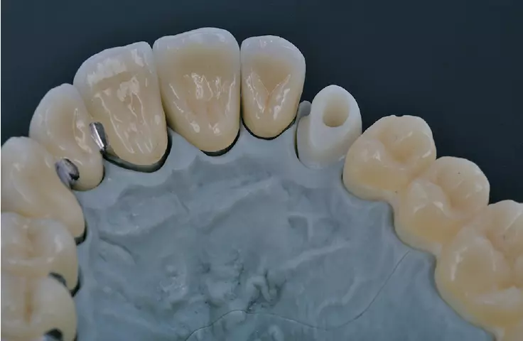 Abb. 10c: Hybrid-Abutment.