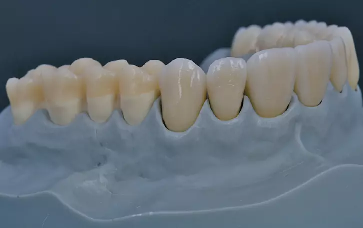 Abb. 10e: Fertige Arbeit von labial.