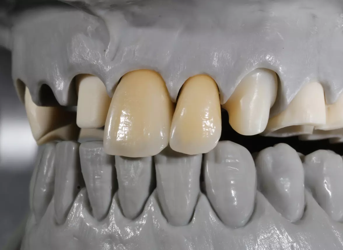 Abb. 2b: Ausgangssituation mit Farbmuster an 21 und 22 und individuellem
Abutment 23.