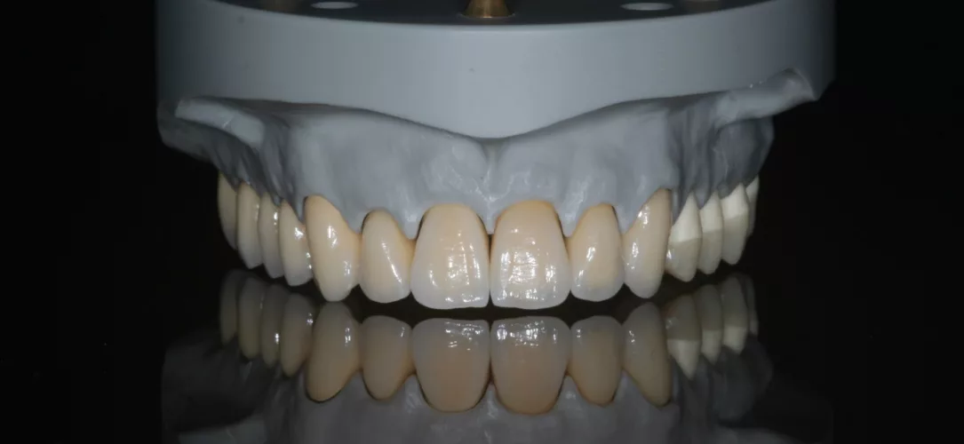 Die fertige Arbeit der praktischen Meisterprüfung mit Metallkeramikbrücke 11–17, Farbmuster 21 und 22, verblendeter Zirkoniumdioxidkrone auf Presskeramik-
Hybrid-Abutment 23 sowie Aufbissbehelf 24–27.