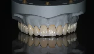 Die fertige Arbeit der praktischen Meisterprüfung mit Metallkeramikbrücke 11–17, Farbmuster 21 und 22, verblendeter Zirkoniumdioxidkrone auf Presskeramik-
Hybrid-Abutment 23 sowie Aufbissbehelf 24–27.