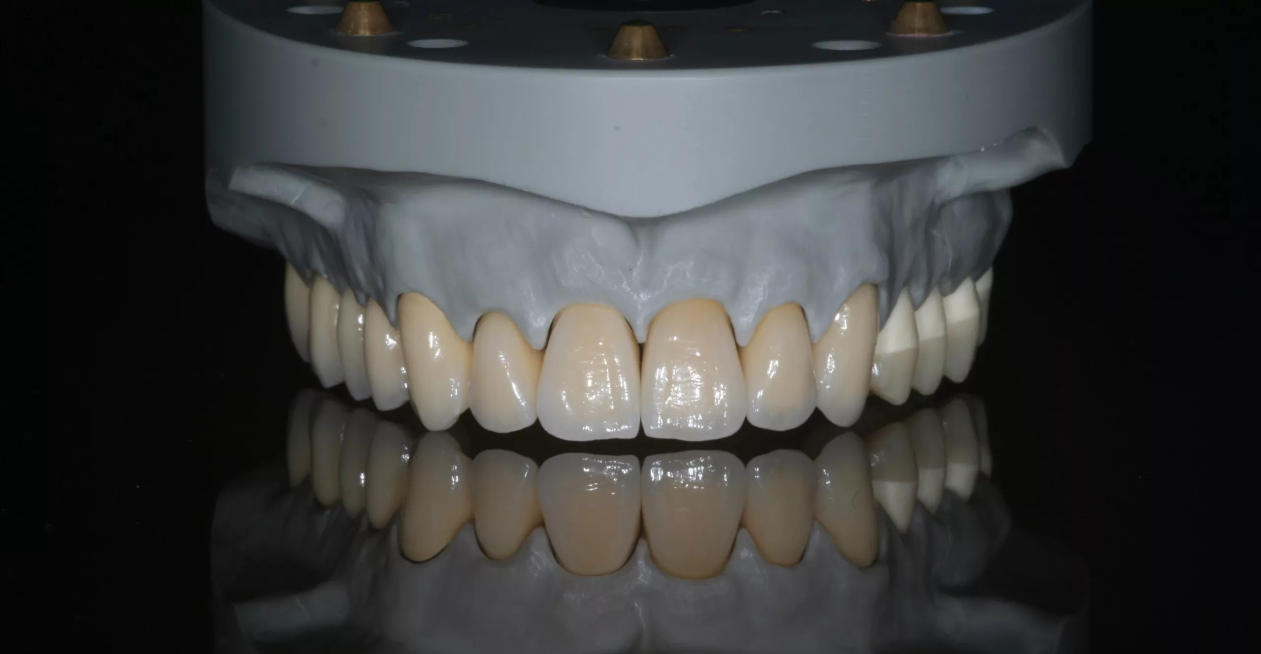 Die fertige Arbeit der praktischen Meisterprüfung mit Metallkeramikbrücke 11–17, Farbmuster 21 und 22, verblendeter Zirkoniumdioxidkrone auf Presskeramik-
Hybrid-Abutment 23 sowie Aufbissbehelf 24–27.