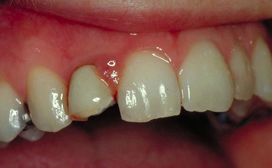 Abb. 1: Zustand nach massivem Chipping an einer Metallkeramikkrone des Zahnes 12; gleichzeitig Gingivitis und Parodontitis vermutlich durch Korrosionsprodukte.