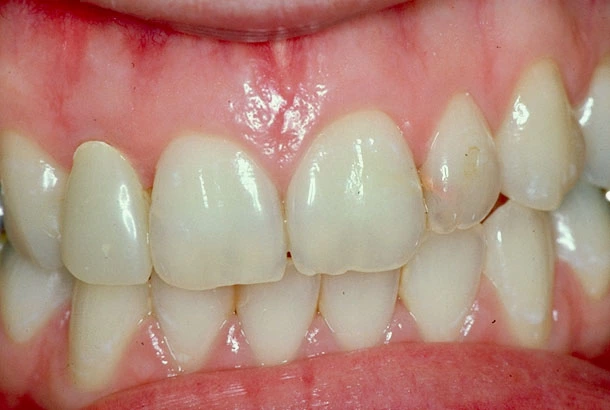 Abb. 3: Eingegliederte Krone aus Lithiumdisilikat: Die parodontale und gingivale Situation haben sich stark verbessert.