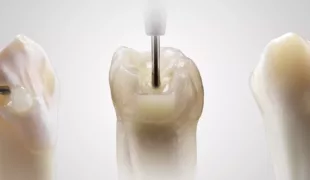 SDR flow+ – ein Material mit gewachsenem Indikationsspektrum.
