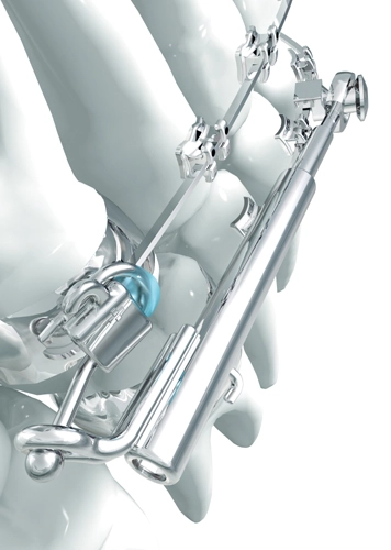 Schonende Klasse II Therapie mit dem Sabbagh Universal Spring (SUS²) Teleskopelement mit Feder.