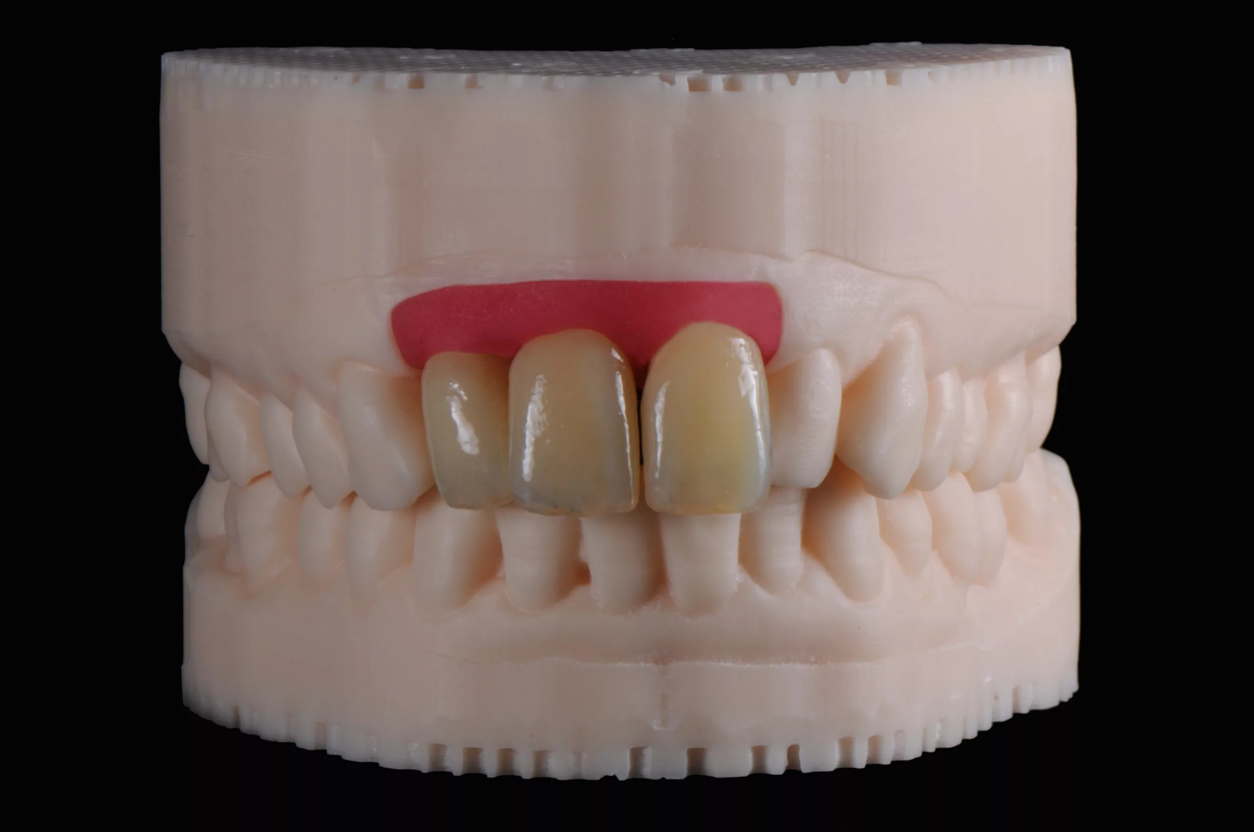 Abb. 8: „Ästhetik-Try-In“-Kronen werden mithilfe des Multimaterial-3D-Drucks in einem Bauprozess in den natürlichen
Schichten hergestellt.