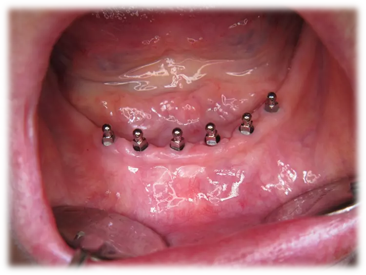 Abb. 2: Sechs Mini-Implantate im Unterkiefer.