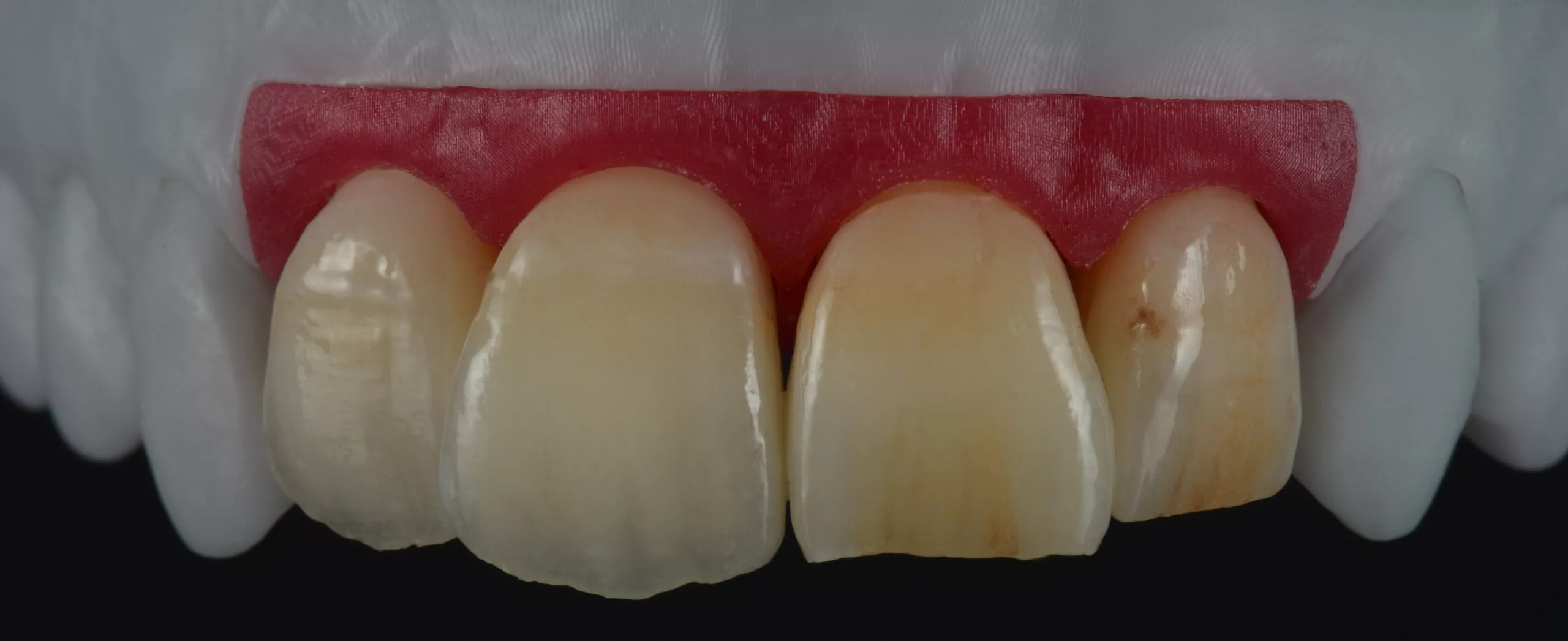 Monolithische Frontzahnrestauration aus Amber Press