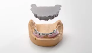 In ausbrennbarem Material gedrucktes Gerüst für eine Chrom-Kobalt-Basis, die anschließend im Labor gegossen wurde.