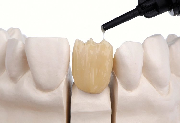 Die Ceramage UP Einzelmassen sind fließfähig, dennoch standfest, leicht modellier-, konturier- und polierbar und für uneingeschränkte Individualisierungen untereinander mischbar.