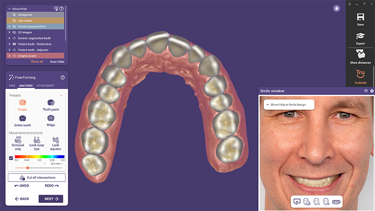 Mit dem Smile Creator Modul können Anwender nun für realistischere Ergebnisse eine virtuelle Gingiva designen und ein Lächeln gestalten, das auf den natürlichen Zähnen des Patienten basiert.