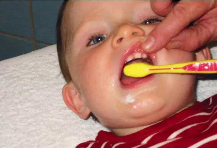 Abb. 2: Zähneputzen mit fluoridhaltiger Zahnpaste stellt die wichtigste Präventionsmaßnahme bezüglich Karies und Parodontopathien dar, vom ersten Zahn an und neben der Plaqueentfernung auch durch die gleichzeitige Lokalfluoridierung. Bei erhöhter Kariesaktivität ist abzuwägen, ob ab 2 Jahren anstelle von Kinderzahnpaste (500 ppm) eine Juniorzahnpaste mit 1.000–1.500 ppm
genutzt werden sollte [6].