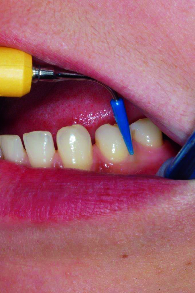 Abb. 4: Der Cavitron SofTip ist zur sanften Entfernung von weichen Belägen und Konkrementen an Implantaten und Abutments entwickelt worden.