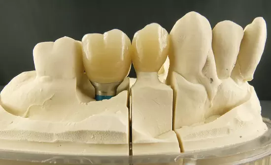 Abb. 29: Ein Großteil unserer bisher analog gelösten Fälle besteht aus gemischten Einzelzahnversorgungen mit Implantaten und natürlichen Zähnen und sind somit Hybridlösungen.