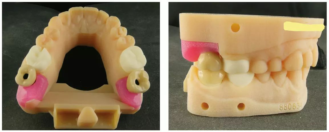 Abb. 34 u. 35: Für sehr empfehlenswert halten wir die Modellherstellung von 3D Medical Print. Hier das Beispiel einer gemischten Abutment-/Stumpf-Situation mit
einer Haltevorrichtung von 3Shape.