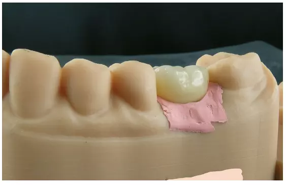 Abb. 37: Unser eigenes Printmodell mit individuell erstellter Zahnfleischmaske.