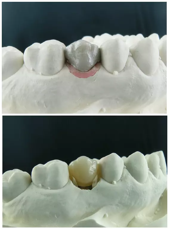 Abb. 45 u. 46: Vorteil der analogen Welt: Vor dem Scannen kann ein Wax-up mit Anpassung der Gingiva und dem Vorbereiten des Emergenzprofils gefertigt werden.