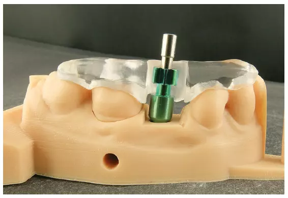 Abb. 51: Kunststoffschiene auf dem eigenen 3D-gedruckten Modell für den Passungsvergleich.